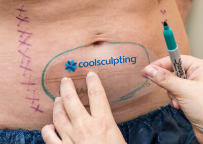 cool sculpting preparations for stomach